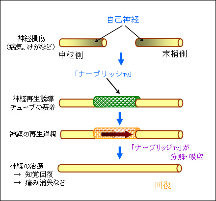 神経再生誘導チューブ「ナーブリッジ™」による治療過程（模式図）