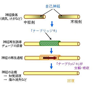 「ナーブリッジ®」を使用した神経の治療過程（模式図）