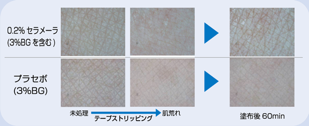 肌荒れにより生じたキメの破壊は、セラメーラを塗布することにより短時間で修復が見られます。