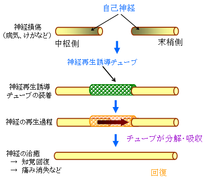 「神経再生誘導チューブ」による治療過程(模式図)